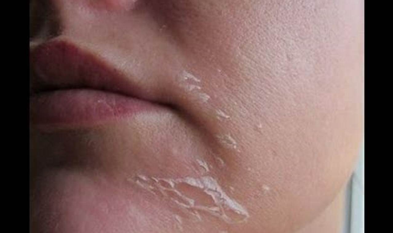 Cara Mengatasi Kulit Wajah Mengelupas